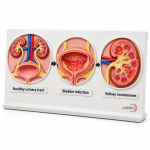 Disease Summary of UTI Model